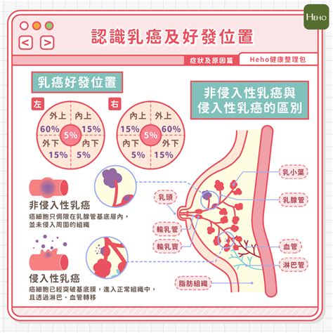 胸部長痣乳癌|乳癌成因、症狀及治療方法